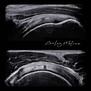 tendinitis supraespinoso granada