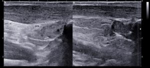 ecografia tendon aquiles
