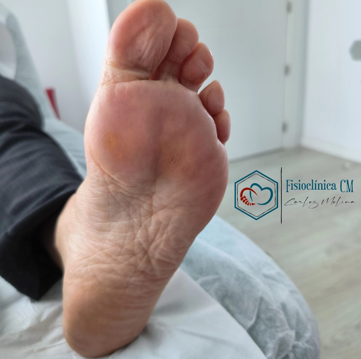 Tendinitis Aquiles Granada tendinitis aquilea