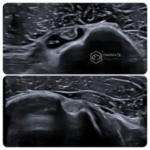 tendinitis bicipital granada